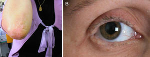 (A) Hyperkeratotic plaques on the skin covering the elbows. (B) Moniliform blepharosis.