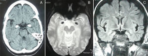 Non-contrast CT displaying bilateral symmetrical hyperdensity, axial T2*-weighted gradient-echo MRI (hypointensity), and coronal FLAIR MRI (hyperintensity) in the amigdalae and unci. Findings were compatible with calcifications.