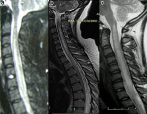 Sagittal cervical T2-weighted MRI sequence. (a) Extensive hyperintense lesion in a patient with ADEM. (b) Extensive hyperintense lesion in an NMO seropositive patient. (c) Extensive hyperintense lesion in a patient with SLE.