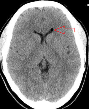 Non-contrast cranial CT scan showing a hypodense lesion in the anterior area of the left lateral ventricle.