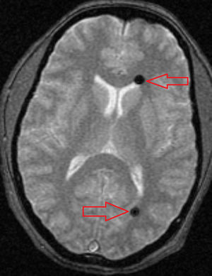 T2-weighted MRI scan showing 2 hypointense lesions in the anterior and posterior areas of the left lateral ventricle.