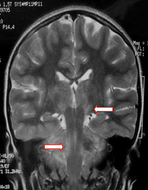 Coronal T2-weighted MR image showing high signal intensity in the basal ganglia, midbrain, and cerebellum.