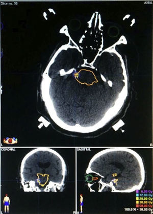 Example of radiosurgery planning with Brainlab® software, using CT images and stereotactic localisation. The target was located 1 to 2mm from the trigeminal RExZ.
