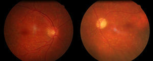 Eye fundus. Left: normal eye fundus in the right eye. Right: papillary atrophy in the left optic nerve and neuroretinal rim pallor.