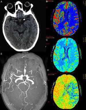 (A) Brain CT showing calcium deposition in the lumen of the proximal segment of the left MCA. (B)–(D) CT-perfusion maps of cerebral blood flow (CBF), cerebral blood volume (CBV), and mean transit time (MTT) showing a large area of the left MCA territory with increased MTT (in blue, D) and decreased CBF (in blue, B). The CBV map (C) shows no significant decreases in volume; the affected area corresponds to the large penumbra. (E) Preocclusive stenosis of the left M1 segment in MRI angiography 3D sequences.