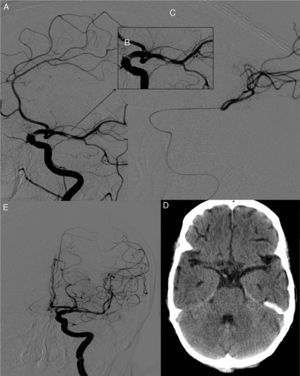 (A) Selective angiography of the left internal carotid artery showing a calcific embolus in the left MCA. (B) Angiography close-up image showing nearly complete occlusion of the vessel. (C) Embolectomy using TREVO; the procedure was successful after a single pass, as shown by the follow-up angiography (D). (E) Follow-up brain CT scan showing no calcific material in the area of the left MCA.