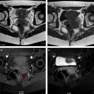 T1- and T2-weighted axial sequences (1, 2). T1-weighted fat-saturated images before and after gadolinium injection (3, 4). T2-weighted imaging displays a hypointense spiculated lesion in the pelvic floor (white arrows), in the left pelvic wall, and at the entry site of the pudendal nerve into the Alcock canal. The lesion (white arrows) shows moderate signal intensity in T1-weighted and T1-weighted fat-saturated sequences. Remnants of haemorrhage are hyperintense (red arrow in 3). Gadolinium uptake in the lesion is heterogeneous (4). Colour images are available in the electronic version of this article.