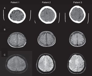 (A) Cranial CT: hyperdense areas in a sulcus of the frontal convexity corresponding to subarachnoid bleeding (left frontal lobe in patients 1 and 3, and right frontal lobe in patient 2). (B) FLAIR MRI: intrasulcal hyperintensity in the area with subarachnoid bleeding as displayed by CT imaging. (C) Gradient-echo MRI revealing microbleeds and superficial haemosiderosis.