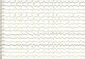 16-Channel EEG showing generalised slowing of background activity with generalised triphasic waves along the entire trace.