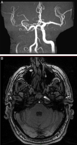 (A, B) Nuclear MRA shows an apparent occlusion of the right internal carotid artery at the level of the carotid sinus 5mm from its root and absence of flow at the base of the skull. The images show a collateral circulation pattern passing through the right anterior communicating artery, with antidromic flow in the anterior cerebral artery filling the ipsilateral middle cerebral artery, which appears attenuated. Collateral circulation is absent in the right posterior cerebral artery.