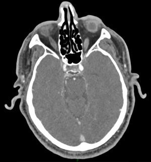 Angio-CT shows flow in the right internal carotid artery at the level of the cavernous sinus. Flow had disappeared at the level of the base of the skull.
