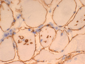 Quadriceps. Dystrophin immunohistochemistry showing enhanced vacuoles.