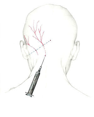 Proximal approach to the greater occipital nerve.