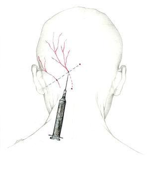Approach to the greater occipital nerve near the muscle insertion point.