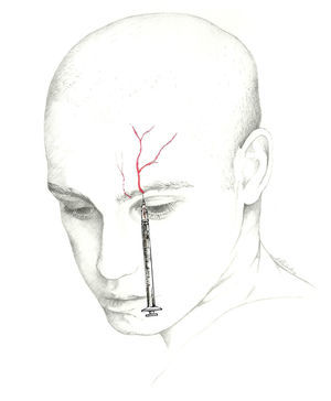 Approach to the supraorbital and supratrochlear nerves.