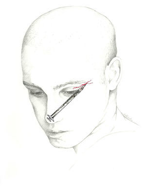 Approach to the lacrimal nerve.