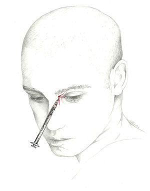 Approach to the infratrochlear nerve.
