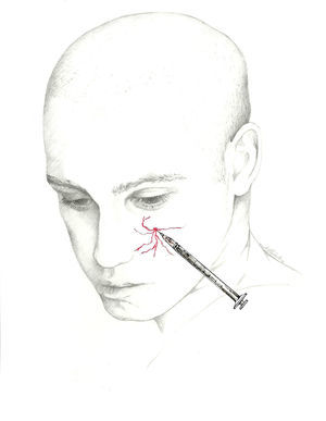 Approach to the infraorbital nerve.