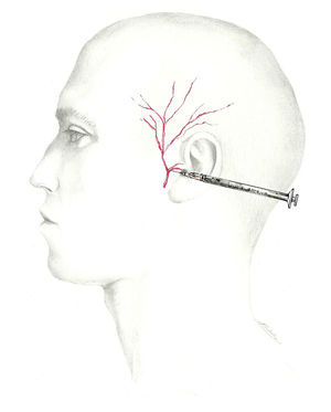 Approach to the auriculotemporal nerve.