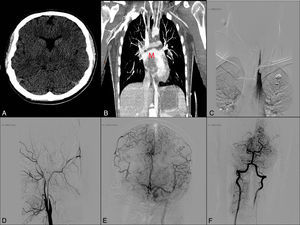 (A) Simple cranial CT scan (axial slice). (B) Thoracic CT-angiography showing an intracardiac mass (M). (C) Thrombus in the left subclavian and vertebral arteries. (D) Artery angiogram (lateral projection) showing occlusion of the right internal carotid artery. (E) Left internal carotid artery angiogram (anteroposterior projection) displaying a thrombus at the bifurcation of the M2 segment of the left middle cerebral artery with considerable pial collateral circulation to the right hemisphere. (F) Angiogram of the right vertebral artery with retrograde flow from the left vertebral artery and occlusion of the P1 segment of the right posterior cerebral artery.