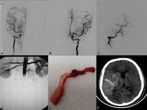 (A) Angiogram of the right internal carotid artery (anteroposterior projection) showing complete recanalisation after the second pass. (B) Left internal carotid artery angiogram (anteroposterior projection) showing complete recanalisation of the middle cerebral artery after the second pass. (C) Left vertebral artery angiogram (anteroposterior projection) showing coil occlusion. (D) An infrarenal abdominal aorta angiogram (anteroposterior projection) conducted after embolectomy revealed occlusion. (E) Thrombus with myxomatous material removed in the embolectomy. (F) Simple, non-contrast CT scan (axial slice) at 24hours. The image reveals hemorrhagic transformation in the right temporoparietal area.