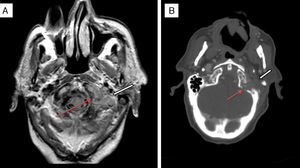 Axial proton density MRI scan (A) and axial cranial CT scan with intravenous contrast (B) showing an osteolytic lesion with bone destruction in the left condyle and left occipital tubercle (thin arrows) and a soft tissue mass (bold arrows) extending to both sides of the bone, invading the foramen magnum, and extending anteriorly to the tip of the odontoid process. The mass also occupies the jugular foramen and hypoglossal canal, and is in contact with the ipsilateral vertebral artery.