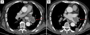 Axial CT scan of the chest with intravenous contrast. (A) Mass in the left infrahilar region with a maximum diameter of approximately 55mm (arrow), with associated hypodense mediastinal adenopathy. (B) Pulmonary nodule measuring 20mm located at the edge of the posterolateral segment of the left inferior lobule (thick arrow), probably linked to the satellite metastatic mass of the primary tumour located in the infrahilar region (thin arrow).