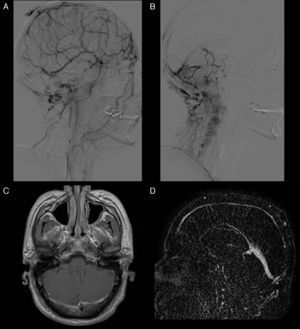 Above: brain angiography. A) Supratentorial cortical venous flow is diverted to the facial and mastoid emissary veins due to chronic occlusion of the superior longitudinal sinus (note that it is irregular and not filled) and partial obliteration of venous flow from the transverse and sigmoid sinuses. These findings were linked to signs of thrombosis. B) Posterior fossa venous blood flow through the mastoid emissary veins. Below: MRI. C) Contrast T1-weighted MRI sequence showing irregular contrast uptake in the transverse sinuses. D) Post-contrast dynamic TRICK sequence acquired during venous phase showing threadlike uptake in the superior longitudinal sinus and marked congestion of the sinus rectus, linked to signs of chronic thrombosis.