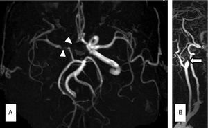 MRA in patient 3 showed moderate stenosis (> 50%) of the right MCA (A) and right ICA occlusion due to dissection (B).