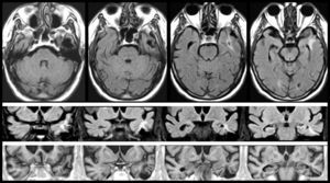 MRI scan of a 78-year-old patient with arterial hypertension and presbycusis who at the age of 53 experienced head trauma resulting in coma. When he was 76, he began to experience recurrent paroxysmal episodes of delusions with visual and auditory hallucinations. Neuroimages revealed encephalomalacia surrounded by gliosis in the left temporal area (upper and middle rows: FLAIR sequences; lower row: T1-weighted IR sequences).