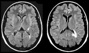 FLAIR MRI sequences from a 57-year-old woman who reported sudden-onset right hypoacusis starting 2 months before the consultation and persisting to date and hearing a sound resembling a waterfall or a river.
