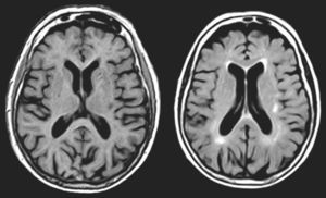 MR images (left: T1-weighted sequence; right: FLAIR sequence) from a 94-year-old woman with arterial hypertension, a 2-year history of bilateral hypoacusis and tinnitus, and a 9-month history of bilateral musical and verbal hallucinations that were repetitive but did not alter the patient
