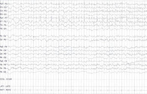 Video-EEG. Continuous epileptiform activity on the left frontal region in the form of 5-Hz rhythmic spikes (EEG activity recorded during barbiturate-induced coma).