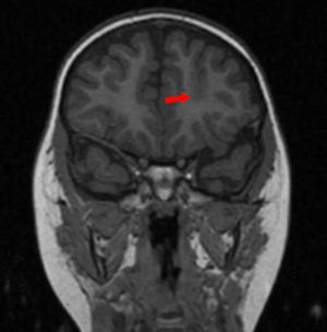 High-resolution (3-T) T1-weighted MRI scan (coronal section) revealing dysplasia at the bottom of the left superior frontal sulcus (loss of differentiation between grey and white matter).