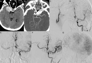 (A) Hyperdense lesion in the region of the cavernous segment of the right ICA corresponding to a thrombosed giant aneurysm. (B) CT-angiography of the circle of Willis revealing no blood flow in the right MCA territory. (C) Digital subtraction angiography with contrast injection into the right CCA revealed no blood flow in the right ICA. (D) Angiography of the left CCA (intracranial projection) showing no abnormalities in the ACoA, adequate filling of the distal portion of right A1, right ACA elevation, and T occlusion in the terminal segment of the right ICA. (E) Selective catheterisation of the right ACA and MCA via the ACoA. (F) Use of Enterprise® stents between the right MCA and the right carotid artery. (G) Angiography (parenchymal phase) showing recanalisation type 2b according to the mTICI scale, associated with delayed venous drainage compared to the left hemisphere.