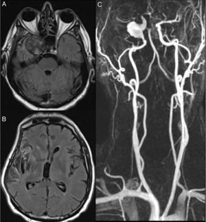 (A) T1-weighted MRI sequence showing an aneurysm in the cavernous segment of the right ICA, which was recanalised, and turbulent blood flow. (B) T1-weighted MRI sequence displaying infarction in the right insular cortex and right temporal operculum. (C) MR-angiography of the supra-aortic trunks revealing a fusiform aneurysm in the right ICA which becomes saccular in the cavernous segment. Artefact caused by a stent between the ACA and the MCA, which makes it difficult to assess the lumen of these arteries.