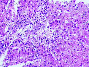 Liver biopsy. Central lobular confluent necrosis with inflammatory infiltration of histiocytes. No signs of fibrosis or chronic hepatocellular disease were seen. These findings were compatible with toxic hepatitis (haematoxylin and eosin ×20).