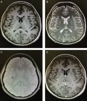 Brain MRI scan performed 24hours after admission. (A) Non-contrast T1-weighted MRI sequence showing a small, well-defined hyperintense lesion in the right insula. (B) T2-weighted MRI sequence revealing a heterogeneous lesion consisting of a hyperintense area with a hypointense rim; the grey matter is not affected. (C) Gadolinium-enhanced T1-weighted MRI sequence showing homogeneous contrast enhancement. (D) Gradient-echo MRI sequence revealing a lesion in the right insula with a dark rim (haemosiderin), demonstrating a “popcorn” appearance.