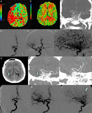 First ischemic stroke (A-F). (A) Multiparametric CT scan: map of mean transit time showing delayed blood flow in the territory of the right MCA. (B) Multiparametric CT scan: map of cerebral blood volume revealing low volume in the right lenticular nucleus. (C) CT-angiography: occlusion of the M1 segment of the right MCA. (D) Angiography: occlusion of the M1 segment of the right MCA. (E and F) Complete recanalisation (TICI grade 3) was achieved with 2 passes. 28hours after the first event (G-L). (G) Brain CT scan showing a small infarction in the right insula and lenticular nucleus (arrow). (H) CT-angiography: occlusion of the M1 segment of the right MCA (arrow). (I) CT-angiography: occlusion of the A3 segment of the right ACA (arrow). (J) Angiography (AP projection): occlusion of the M1 segment of the right MCA. (K and L) Recanalisation of the MCA (TICI grade 2B) and persistent occlusion of the A3 segment of the right ACA (arrow).