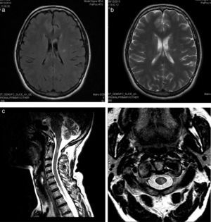 (a) FLAIR sequence showing signal hyperintensity in the left periventricular white matter extending towards the corona radiata and left centrum semiovale. (b) T2-weighted sequence displaying an area of probable malacia-gliosis. (c) Sagittal and (d) axial T2-weighted sequences showing a hyperintense lesion measuring 5mm×4mm×1.3mm in the cervical spinal cord, at the level of the middle third of the odontoid process.