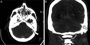 CT-angiography showed arterialisation of the left sigmoid sinus (A) and engorgement of branches of the left external carotid artery (B).