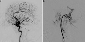 Arteriography revealed a DAVF in the posterior fossa, fed by the interior (a) and exterior (b) carotid arteries, with venous drainage through the transverse and sigmoid sinuses and cortical veins (Cognard II a+2).