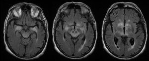 Brain MRI (axial slices, FLAIR sequences) in patients with limbic, diencephalic, and midbrain encephalitis associated with anti-Ma antibodies.