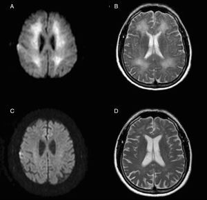 Axial MRI images obtained 3 weeks after the hypoxic event, with restricted diffusion in the diffusion-weighted sequence (A) and hyperintensity in the T2-weighted sequence (B) extensively affecting the whole periventricular white matter. Below, diffusion-weighted (C) and T2-weighted sequences (D) obtained one year later show the resolution of both alterations.