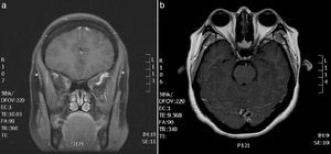 (A) Brain MRI scan: gadolinium-enhanced T1-weighted coronal sequence showing signal alterations in the right cavernous sinus. (B) Brain and orbital MRI scan: gadolinium-enhanced T1-weighted axial sequence revealing asymmetrical contrast uptake in the orbital apex and the lateral wall of the right cavernous sinus.