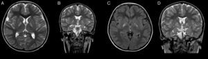 MRI slices revealing hyperintensities in both globus pallidi. (A) Axial T2-weighted sequence; (B) coronal T2-weighted sequence; (C) axial FLAIR sequence at 2 months after A and B; (D) coronal T2-weighted sequence (2 months after A and B).