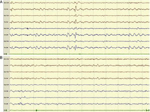 Example of an 8-channel emergency EEG recording showing initial epileptiform anomalies (EA) of generalised expression, predominating in posterior regions (compatible with NCSE), in a patient with episodes of disorientation (A) and the subsequent disappearance of the EAs (B). We observed a posterior alpha background activity and anterior fast rhythms, accompanied by clinical improvement, after the administration of IV diazepam.