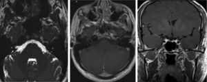 A follow-up MRI scan performed at 4 months revealed resolution of contrast uptake and thickening of the mandibular and maxillary branches of the trigeminal nerve.