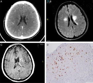 Neuroimaging and anatomical pathology findings. (A) Cranial CT scan showing bilateral focal hypodensities in the area around the ventricles, internal capsule, and thalamus. (B) FLAIR and (C) T1-weighted sequences. A brain MRI scan revealed lesions to the corona radiata, basal ganglia, and thalamus, predominantly in the left hemisphere, as well as slight oedema and contrast uptake. (D) Anatomical pathology study of brain tissue showing JC virus infection (SV40 antibody staining).