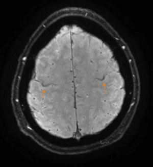 Brain MRI, SWI sequence. A hypointense rim is visible on the hand knob of the precentral gyrus.